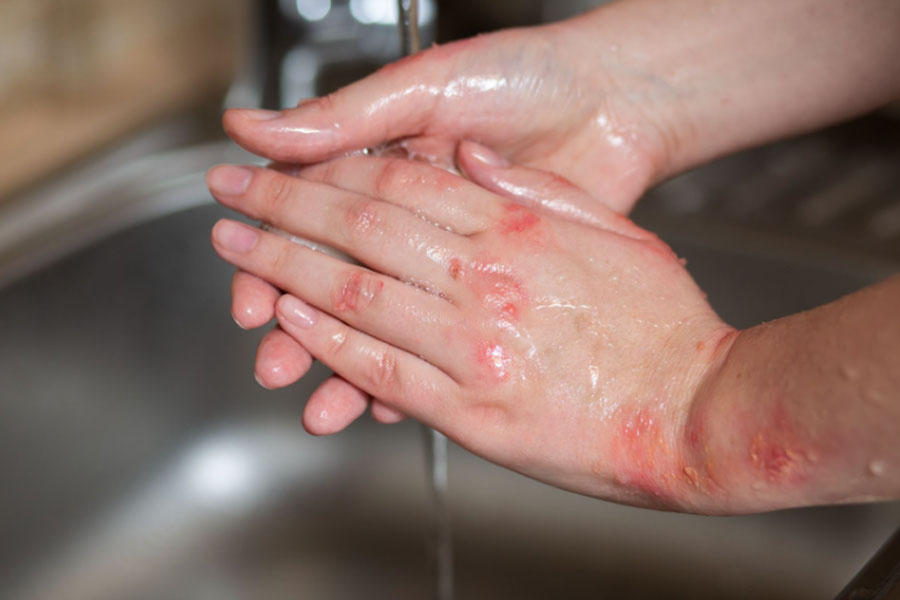 Skin damages  from hard water